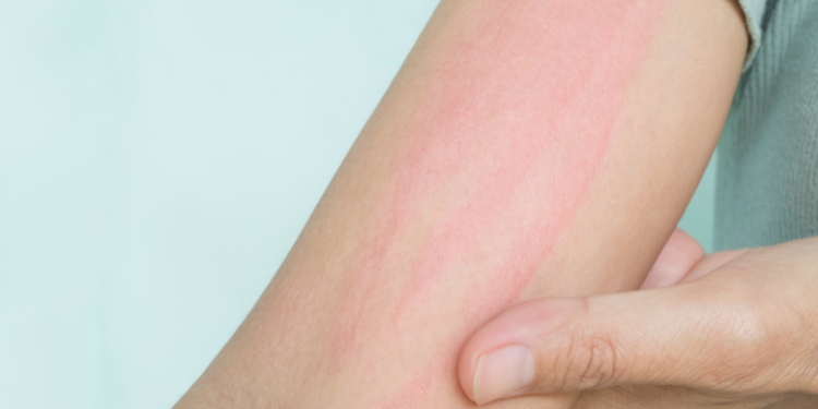intoleranta la histamina, tulburari metabolice, alergii, simtome intoleranta la histamina, remedii intoleranta la histamina, alimente cu histamina, 