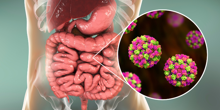 infectia cu norovirus, gastroenterita, virus norwalk, infectia cu virus Norwalk, simptome norovirus, preventie norovirus, remedii notovirus, 