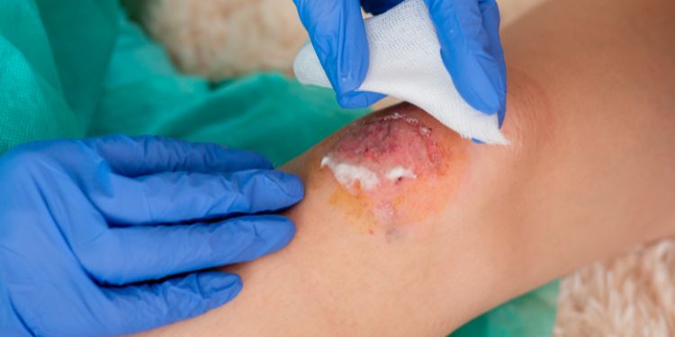 peroxid de hidrogen beneficii, peroxid de hidrogen precautii, apa oxigenata rani, apa oxigenata utilizari,