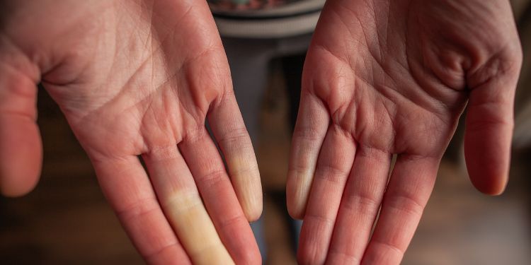 sindromul Raynaud, buze vinete,