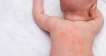 Miliaria, de la cauze și simptome la prevenție și tratament