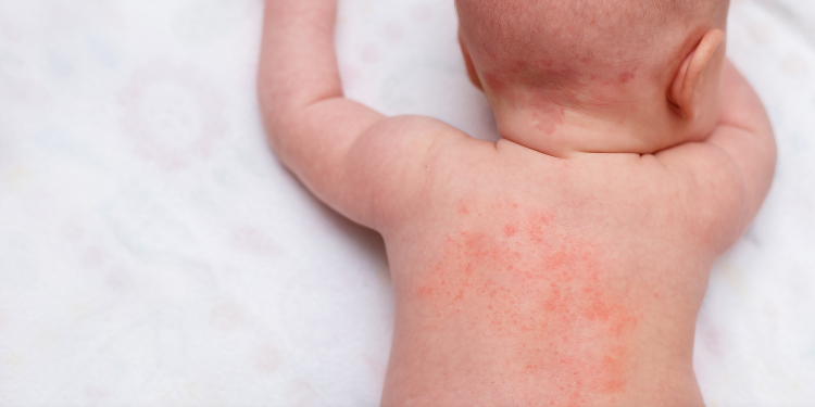 Miliaria, de la cauze și simptome la prevenție și tratament