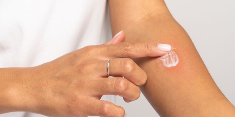 crema intepaturi insecte, criterii alegere crema intepaturi insecte,