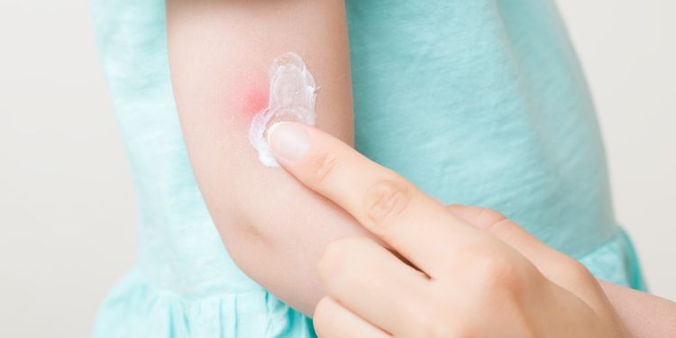 unguent pentru intepaturi de insecte la copii cum sa il alegi, unguent pentru intepaturi de insecte la copii, intepaturi de insecte la copii, 