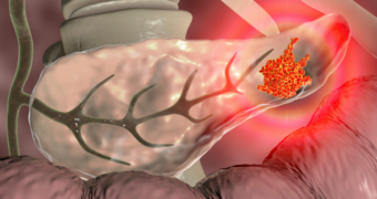Neoplasm pancreatic: ce este și cum apare? Simptomele neoplasmului pancreatic