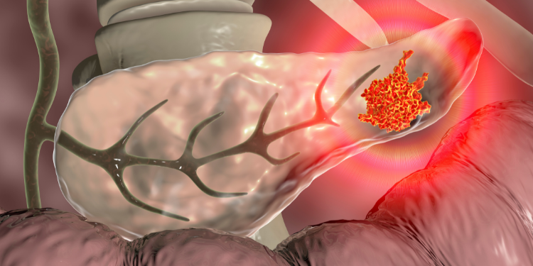 Neoplasm pancreatic: ce este și cum apare? Simptomele neoplasmului pancreatic