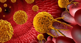 Adenocarcinom: clasificare, diagnostic și abordări terapeutice