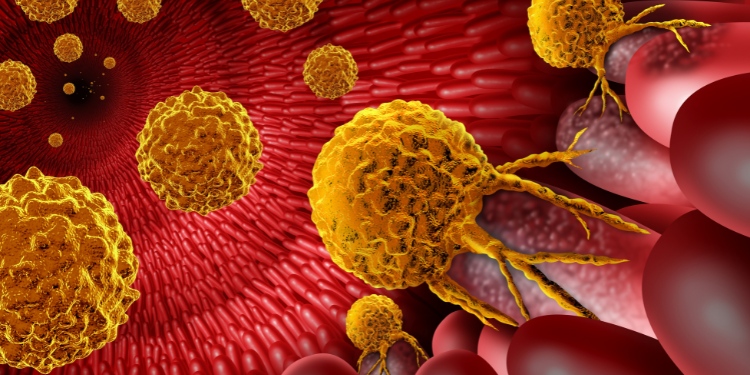 Adenocarcinom: clasificare, diagnostic și abordări terapeutice