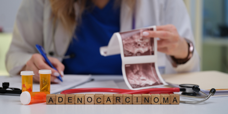 adenocarcinom, cancer, diagnostic adenocarcinom, tratament adenocarcinom, 