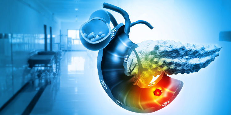 neoplasm pancreatic, cancer de pancreas, simptome neoplasm pancreatic, diagnostic neoplasm pancreatic, tratament neoplasm pancreatic, 