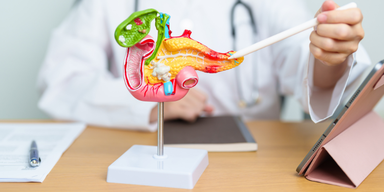 neoplasm pancreatic, cancer de pancreas, simptome neoplasm pancreatic, diagnostic neoplasm pancreatic, tratament neoplasm pancreatic, 