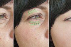 (P) Blefaroplastia nu e despre a te schimba. E despre a te întoarce la tine