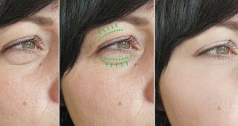 (P) Blefaroplastia nu e despre a te schimba. E despre a te întoarce la tine