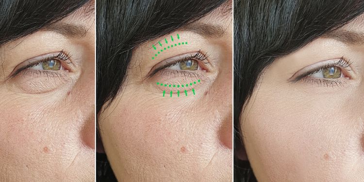 (P) Blefaroplastia nu e despre a te schimba. E despre a te întoarce la tine