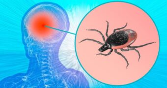 Encefalita de căpușă – cauze, simptome, diagnostic. Cum o prevenim