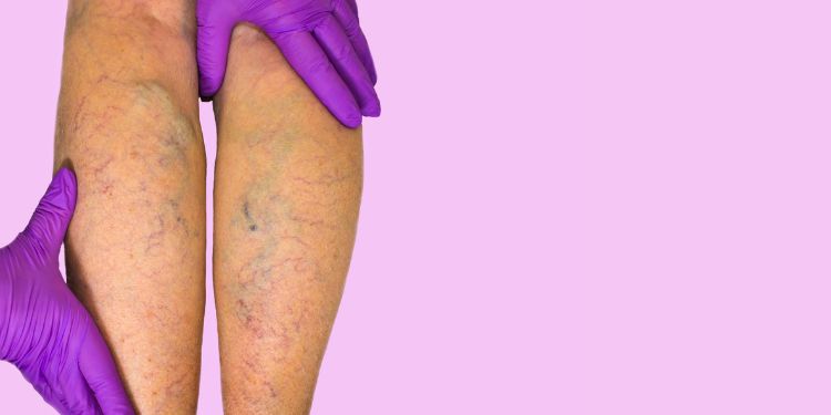 diosmina si hesperidina beneficii circulatie, diosmina si hesperidina utilizari terapeutice, diosmina si hesperidina efecte secundare, diosmina si hesperidina recomandari,