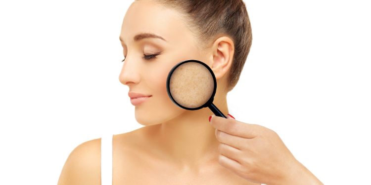 melasma simptome, melasma tratament, melasma optiuni terapeutice, optiunile terapeutice si radiatiile UV, melasma si cosmeticele,
