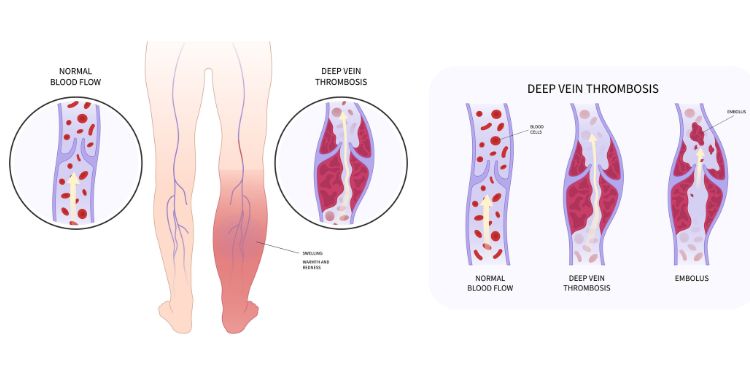 ce afectiuni depisteaza ecografia Doppler, cine are nevoie de ecografie Doppler, cum functioneaza ecografia Doppler,