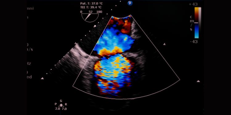 ce este o ecografie Doppler, cand se recomanda o ecografie Doppler,