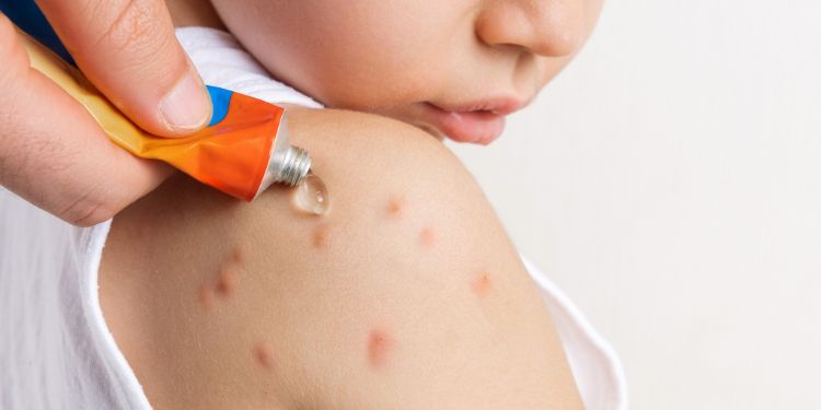 ce este un gel intepaturi de insecte, recomandari pentru intepaturi de insecte, Assista RepelX Gel pentru intepaturi insecte,