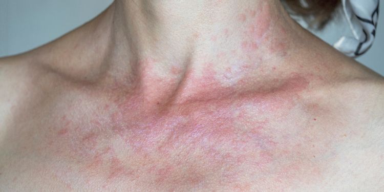 iritatii de la caldura, tipuri de iritatii de la caldura, cum prevenim iritatiile de la caldura, cum tratam corect iritatiile de la caldura, cum sa recunoasteti iritatiile de la caldura, remedii care pot ajuta in iritatiile de la caldura, cand trebuie sa mergi la medic pentru iritatiile de la caldura,