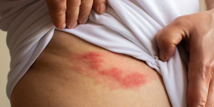 zona zoster si vaccinul de varicela, legatura dintre zona zoster si varicela,