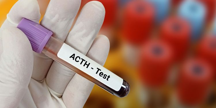 diagnostic cortizol marit, cum previi cortizolul marit, cortizolul marit si sindromul Cushing, sindromul Cushing cauze, simptome sindromul Cushing, sindromul Cushing diagnostic,