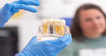 (P) De ce implanturile dentare au o rată de succes de peste 95%?