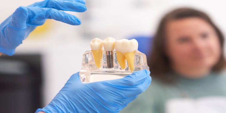 (P) De ce implanturile dentare au o rată de succes de peste 95%?