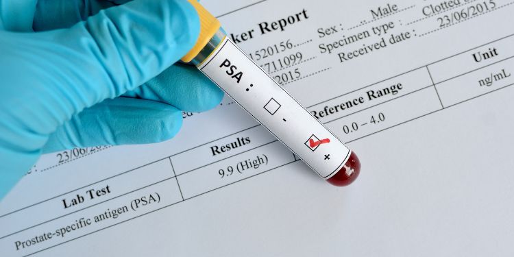 cum se stabileste diagnosticul, PSA,