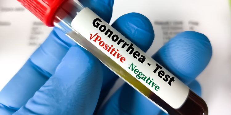 infectia cu Neisseria gonorrhoeae, 