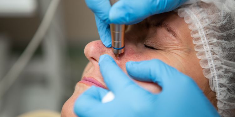 tratamentul si managementul rozaceei, rutina de ingrijire zilnica in rozacee, preventia exacerbarilor in rozacee,
