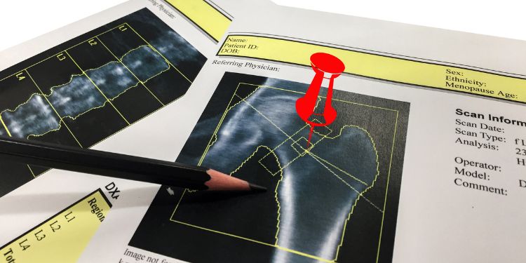 DEXA osteodensitometrie pentru osteoporoza, 