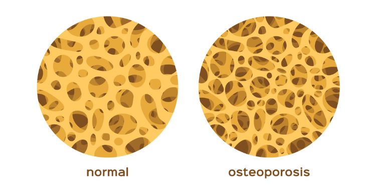 metode de diagnostic pentru osteoporoza, osteoporoza tratament, osteoporoza complicatii, 