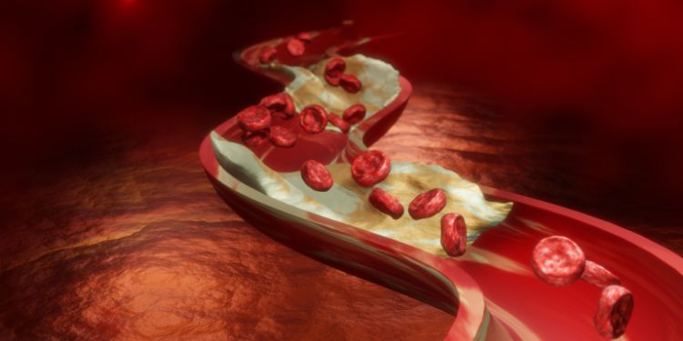 infarct miocardic, atac de cord, aterom,