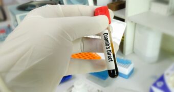 Test Coombs direct. Ce este? Cum se efectuează? Ce indică rezultatele?