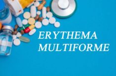 Eritem multiform. Cauze, simptome, tratament și sfaturi medicale