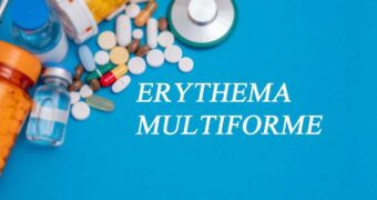 Eritem multiform. Cauze, simptome, tratament și sfaturi medicale