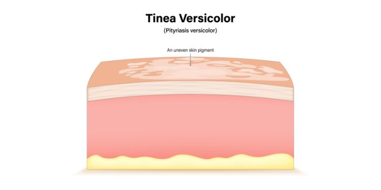 cauze pitiriazis versicolor, pitiriazis versicolor este contagioas,