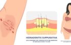Hidradenita supurativă: cum apare și ce cauze are, cum se diagnostichează și cum se tratează