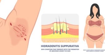 Hidradenita supurativă: cum apare și ce cauze are, cum se diagnostichează și cum se tratează