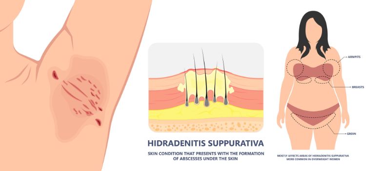 Hidradenita supurativă: cum apare și ce cauze are, cum se diagnostichează și cum se tratează