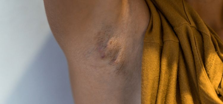 simptome hidradenita supurativa, transpiratia si hidradenita supurativa, cum se pune diagnosticul de hidradenita supurativa, 
