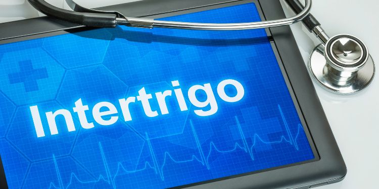 cum se diagnosticheaza intertrigo, unguentele pentru intertrigo, intertrigo complicatii,