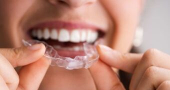 (P) Ce probleme poate corecta un aparat dentar și când este recomandat consultul ortodontic?