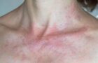Fotodermatoza: cauze, simptome, tratament și metode de protecție