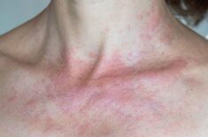 Fotodermatoza: cauze, simptome, tratament și metode de protecție
