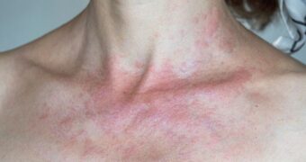 Fotodermatoza: cauze, simptome, tratament și metode de protecție