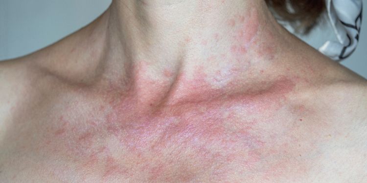 Fotodermatoza: cauze, simptome, tratament și metode de protecție