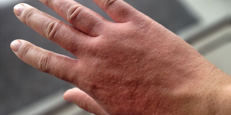 de ce apare fotodermatoza, tipuri de fotodermatoza,
